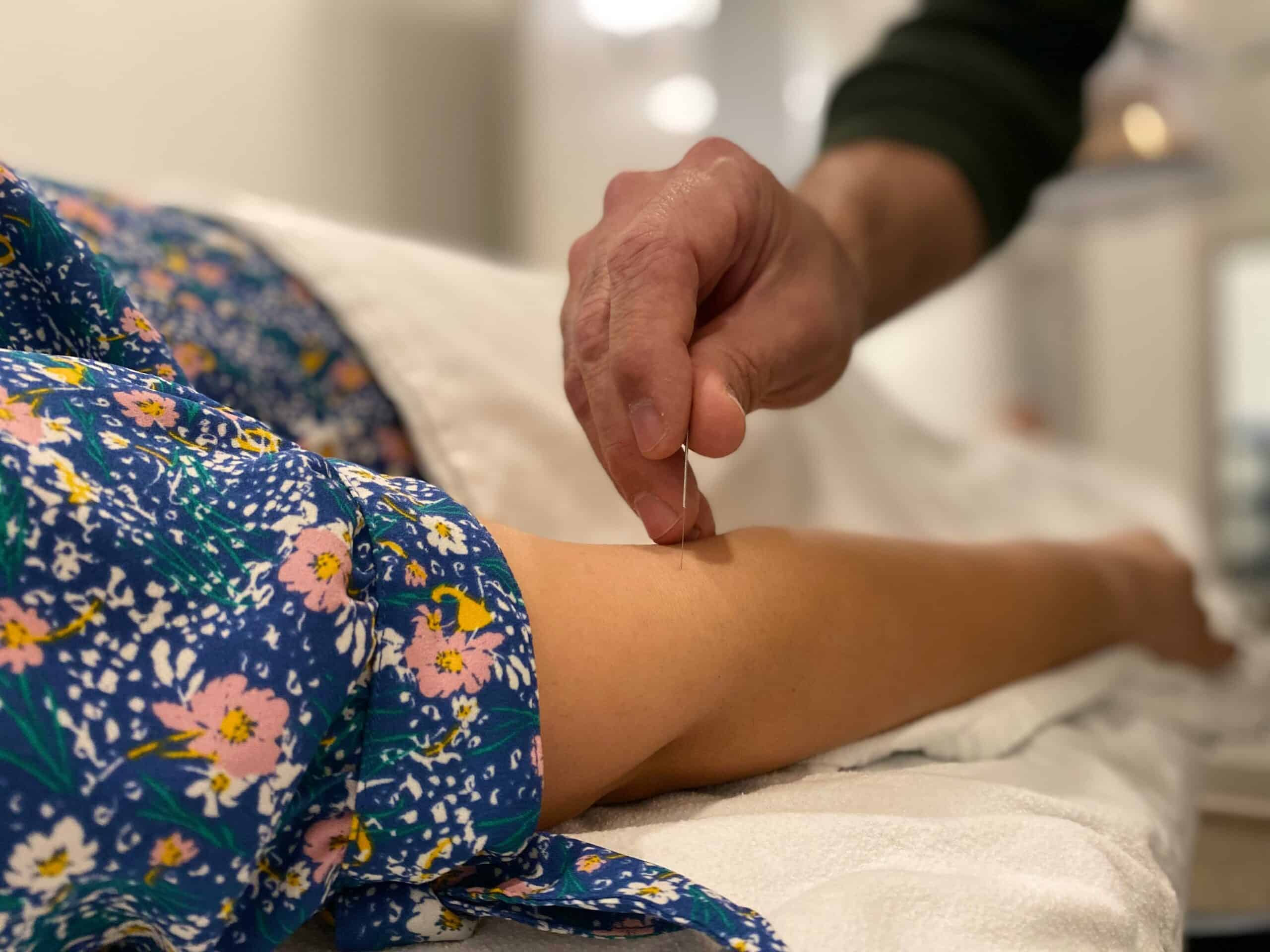 Does Acupuncture Help Migraines: What the Evidence Actually Shows