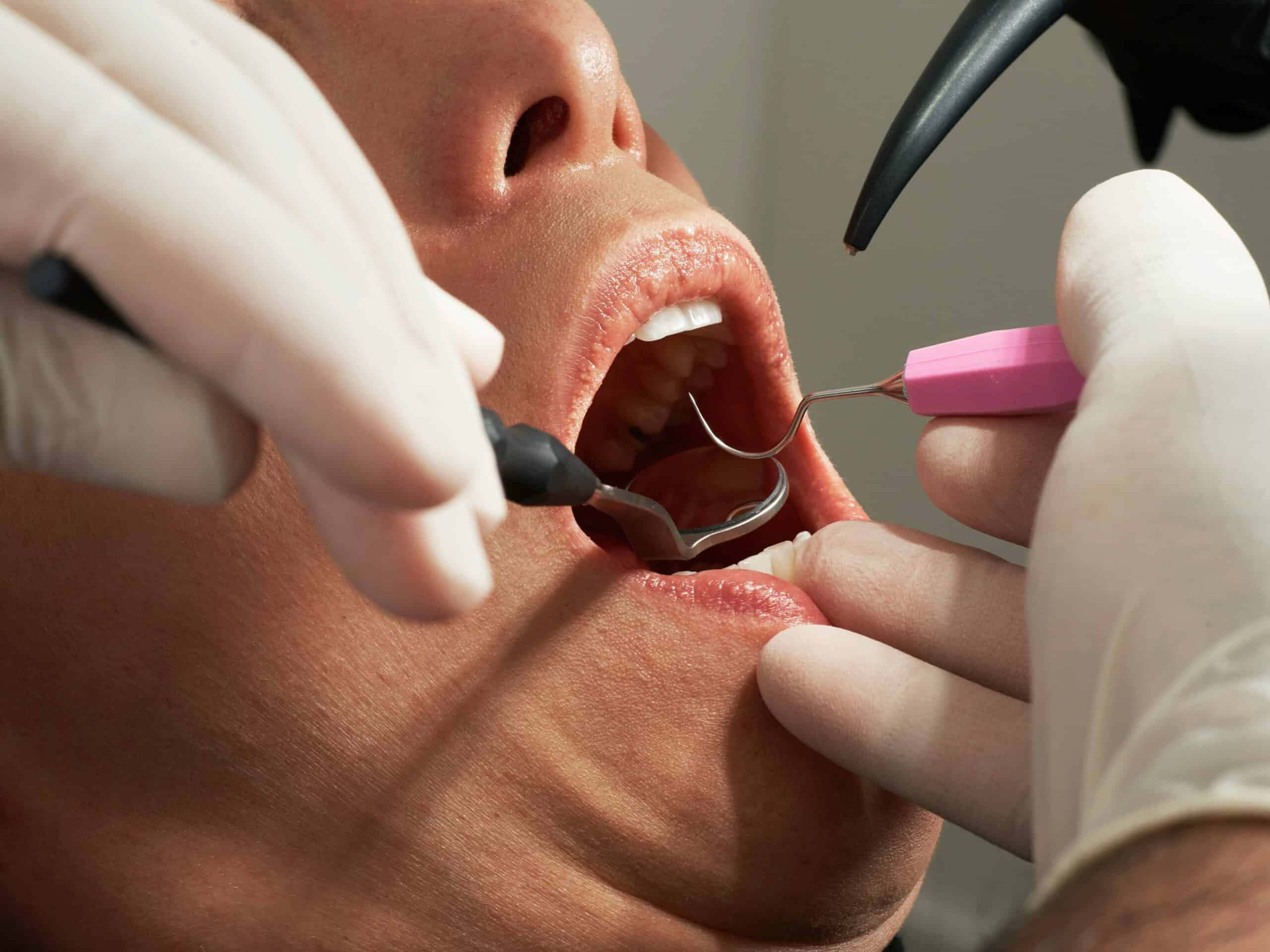 Can Dental Work Trigger a Migraine? What Happens in the Chair and How to Plan Around It